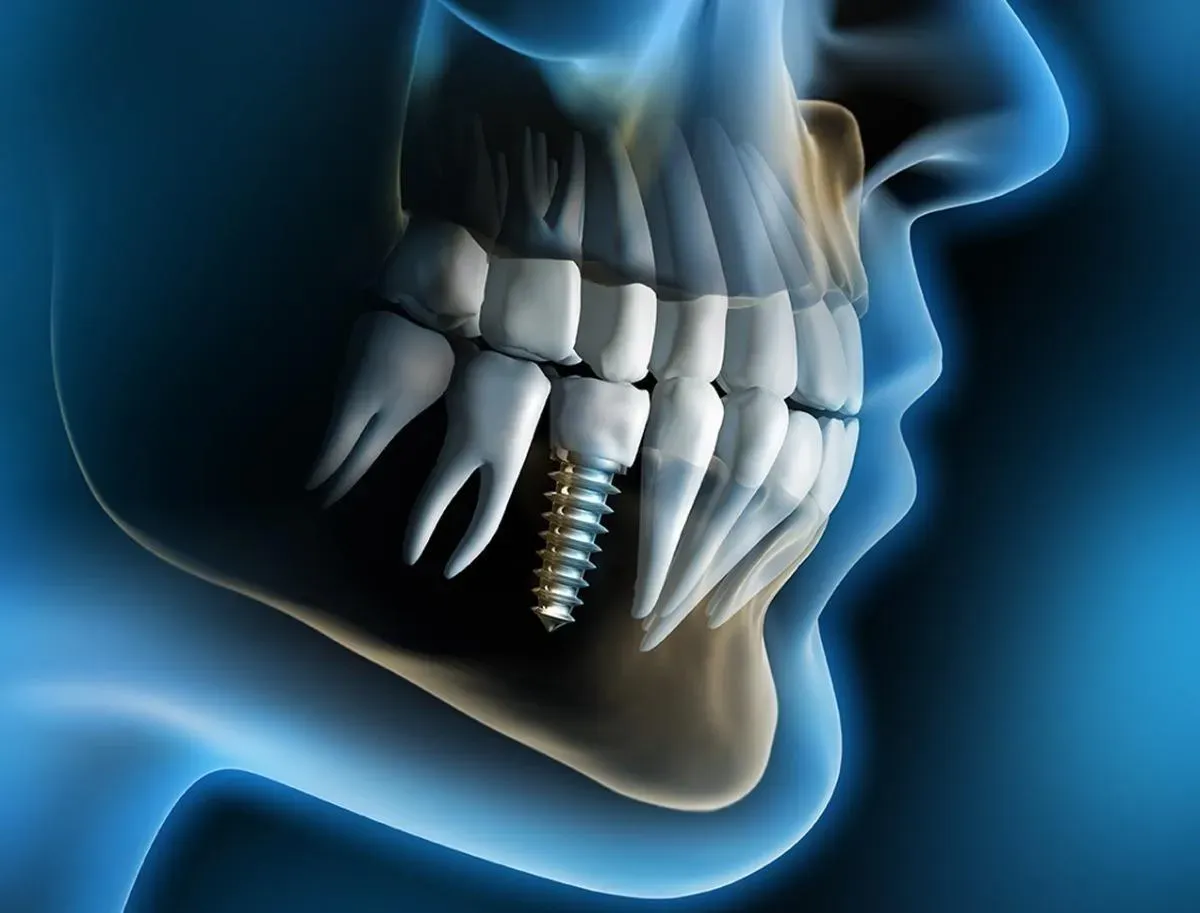 Dental Implants Placed by Our Skilled Periodontist