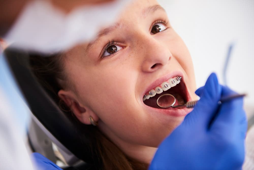 Lets Talk Braces!