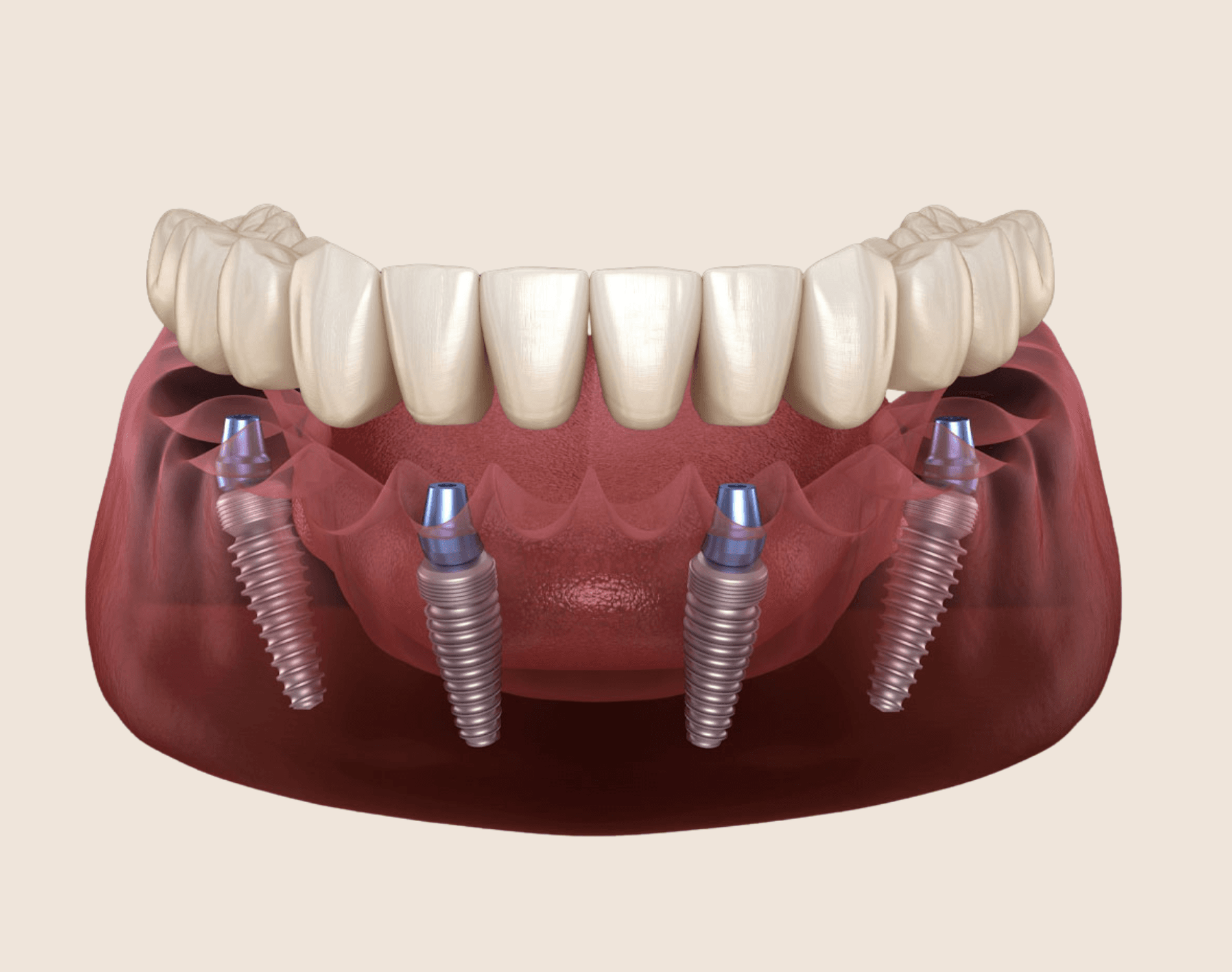 All-on-4 Dental Implants