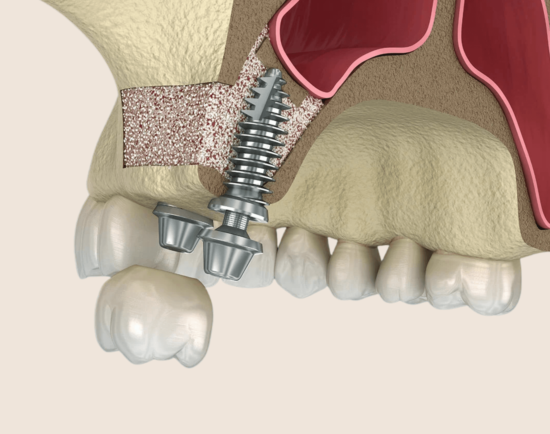 Bone Grafting
