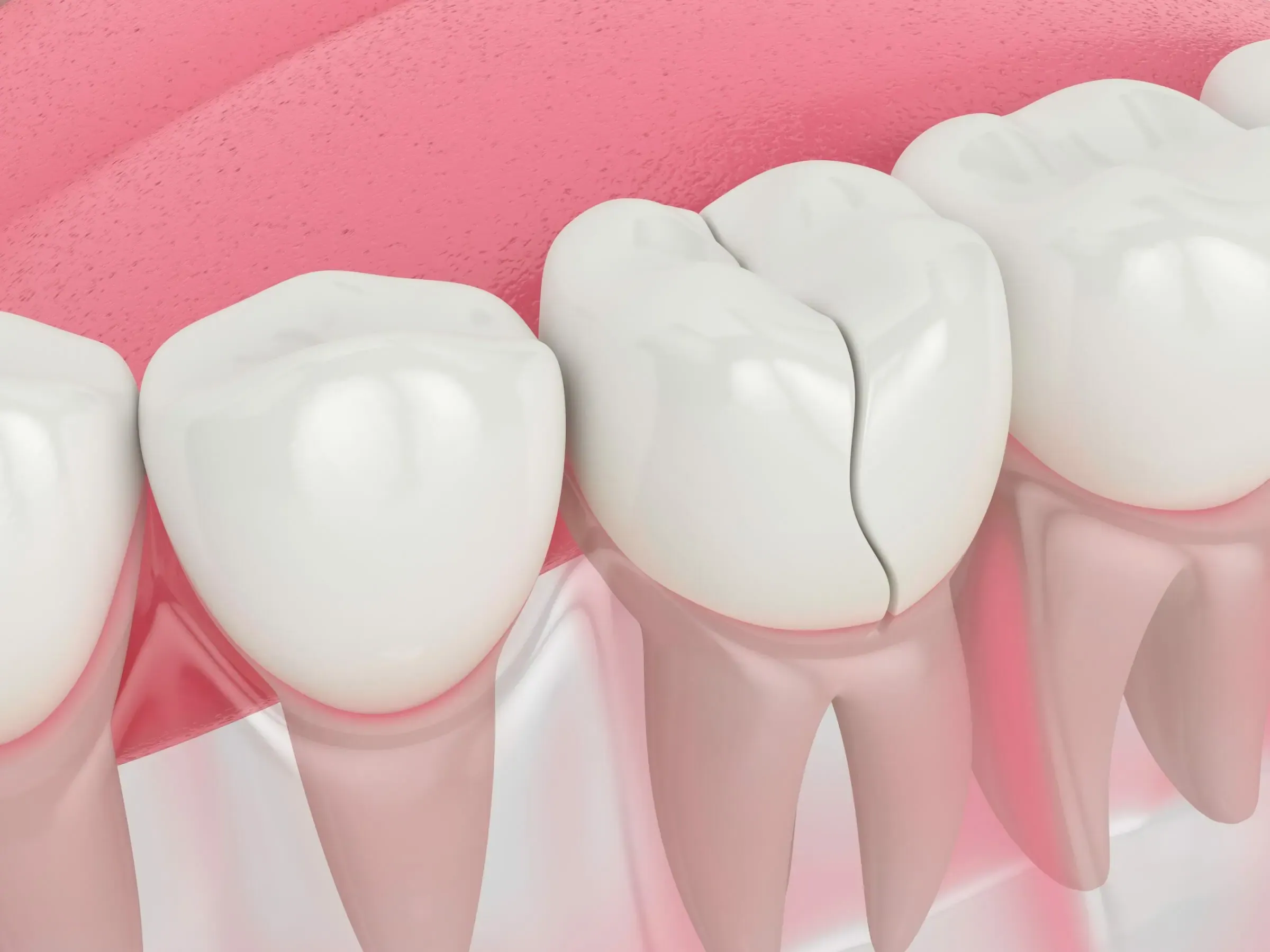 Broken or Cracked Tooth Repair