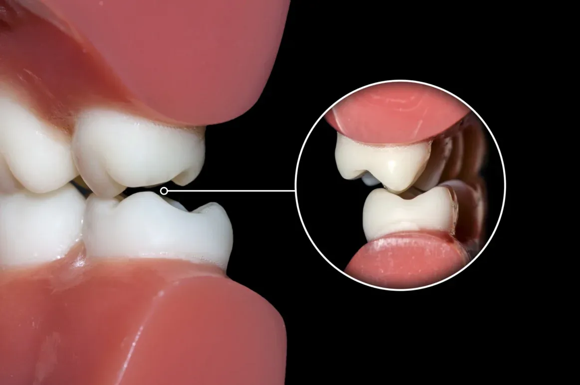 Bruxism (Teeth Grinding) Treatment