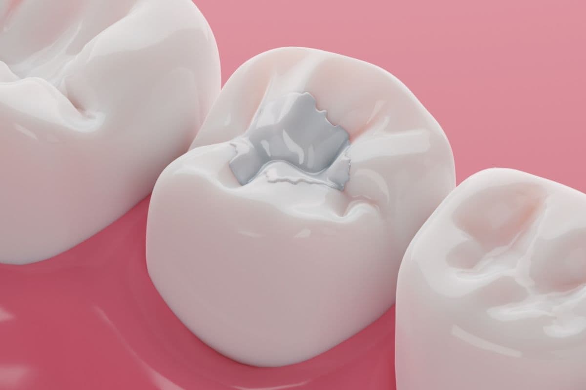 Children's Sealants