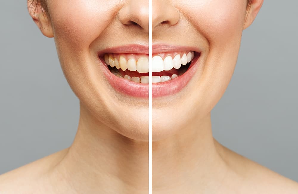 Cosmetic Gum Contouring