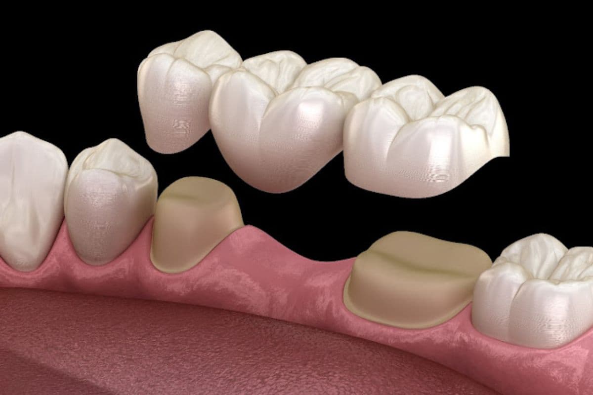 Dental Bridges
