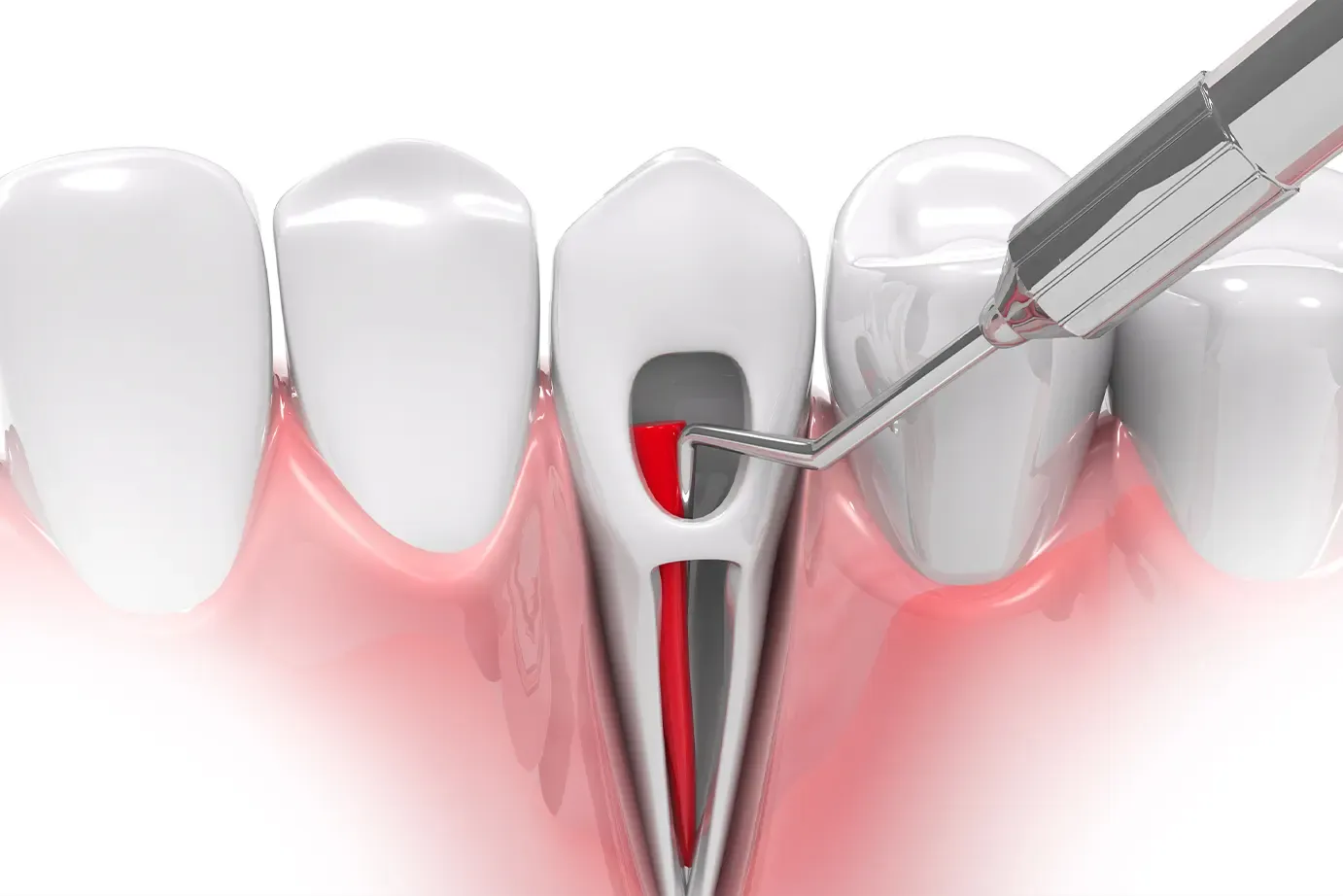 Emergency Root Canal