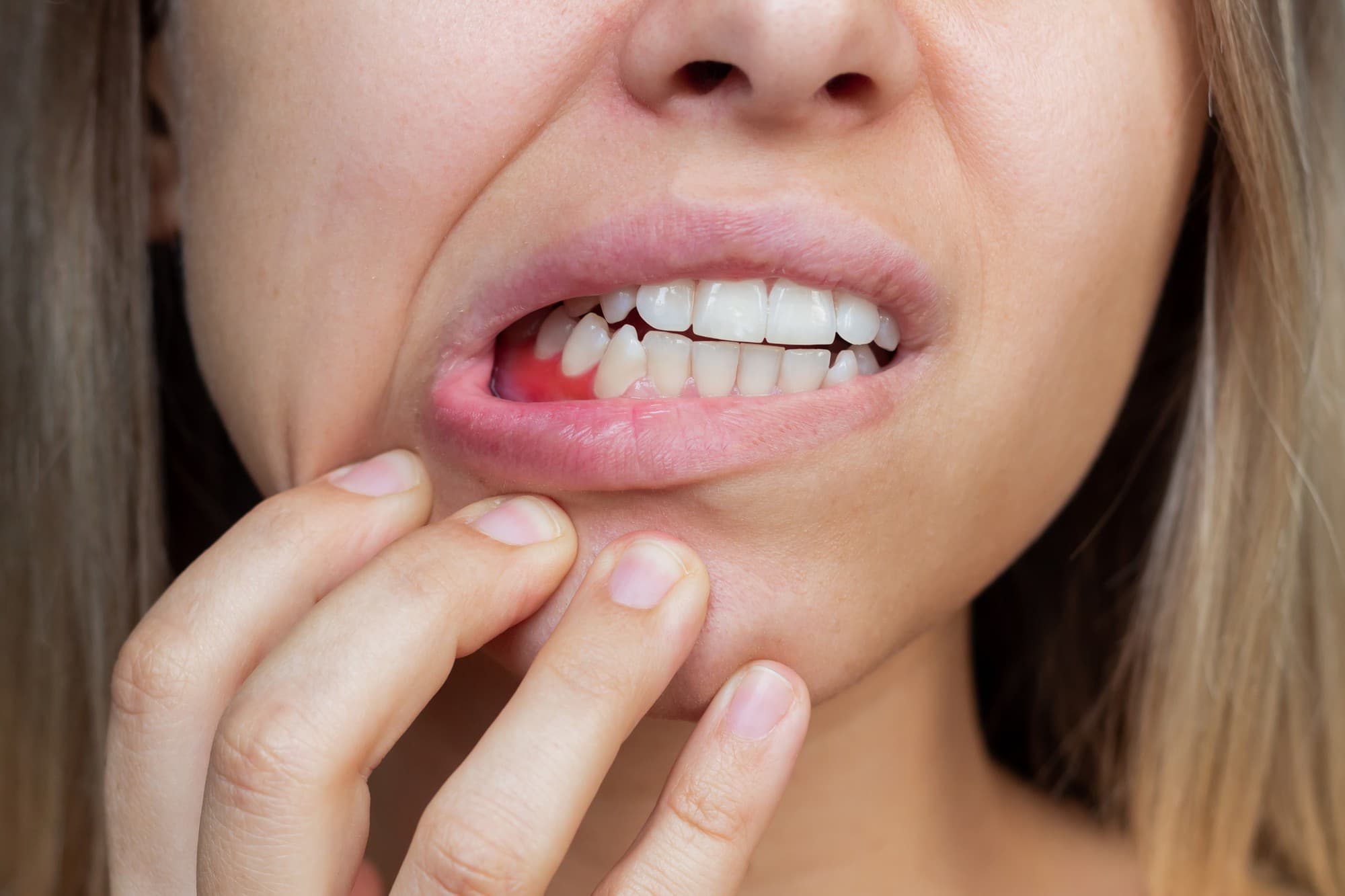 Gum Recession Treatment