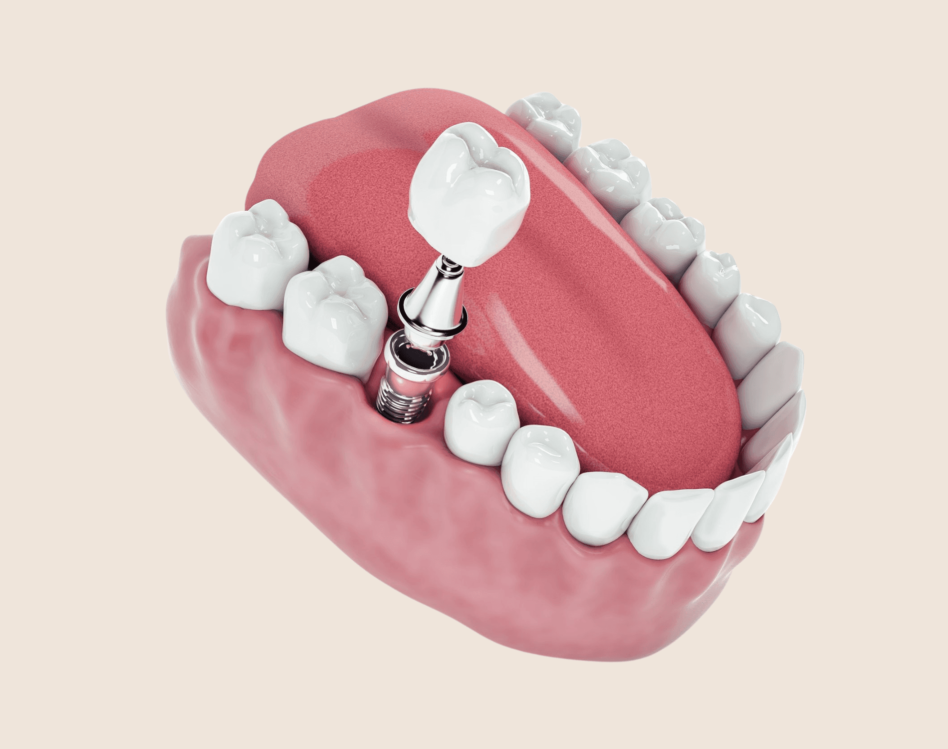Implant Specialist