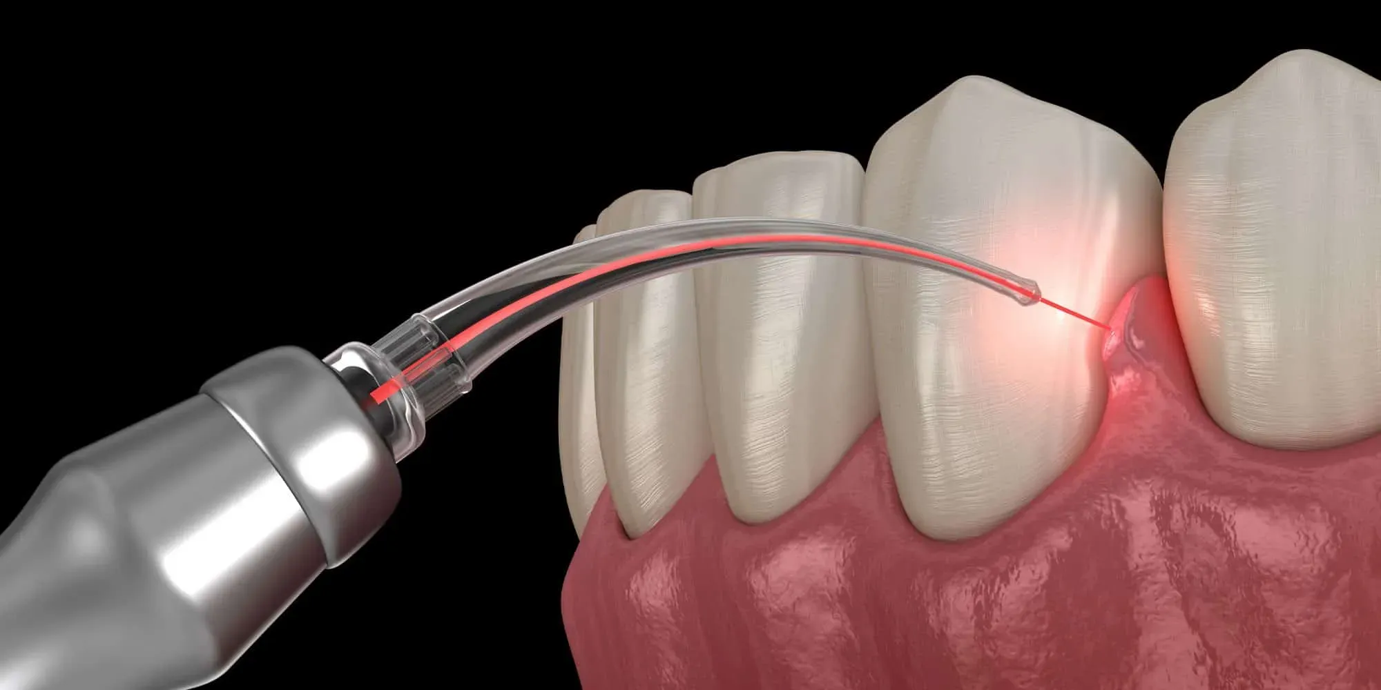 LANAP Procedure treatment at Smiles4Life Dental & Braces, Thousand Oaks