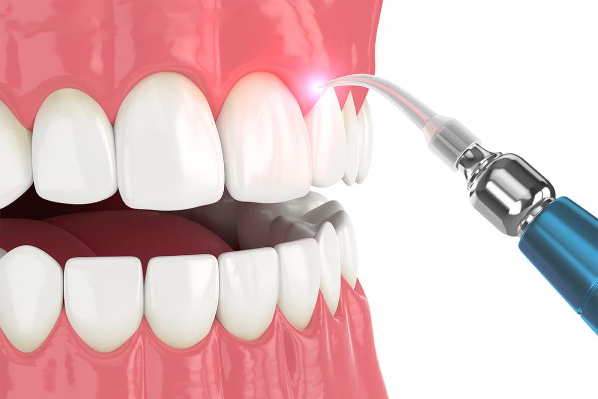 Laser Gum Therapy treatment at Smiles4Life Dental & Braces, Thousand Oaks