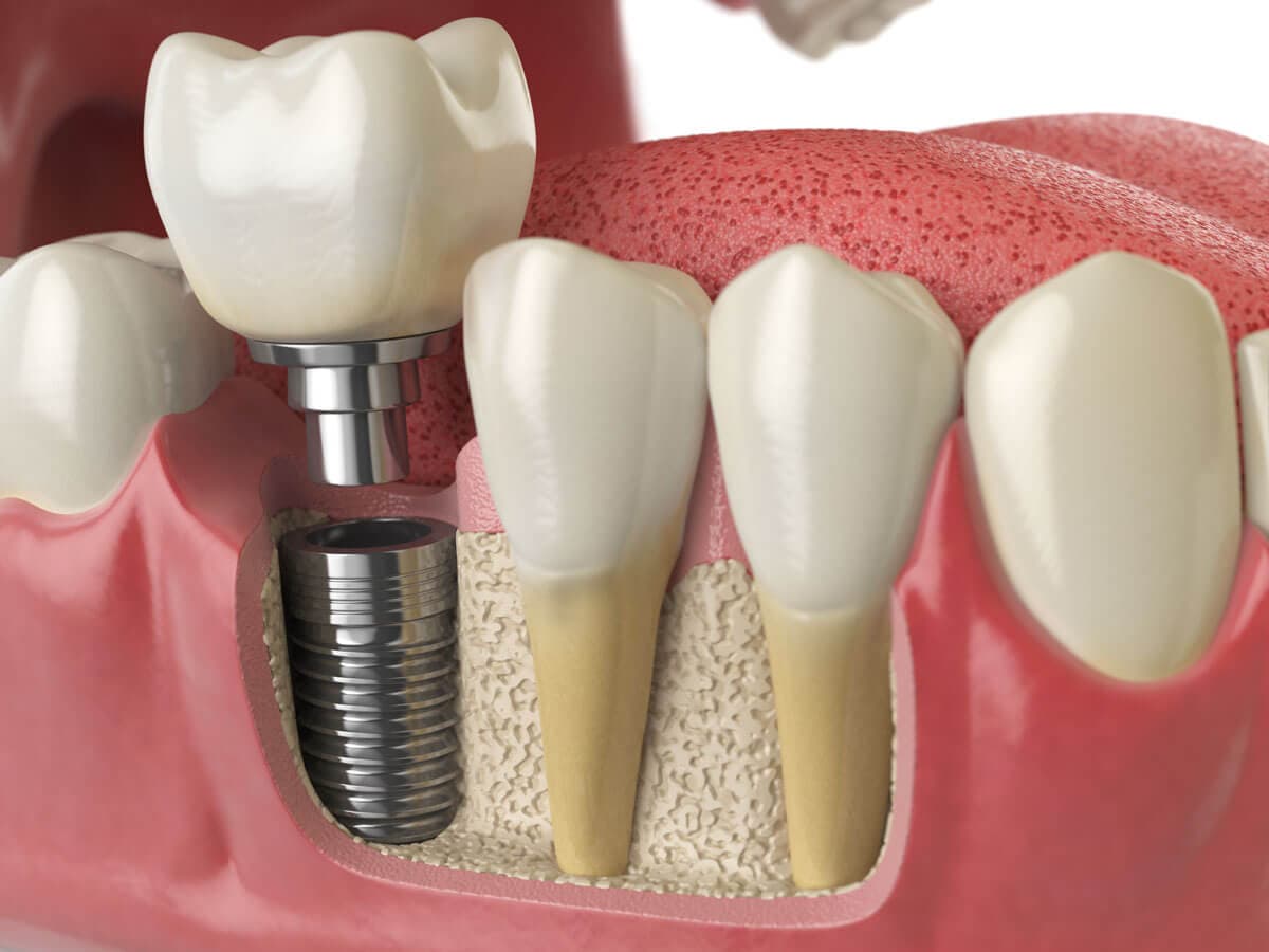 Permanent Tooth Replacement
