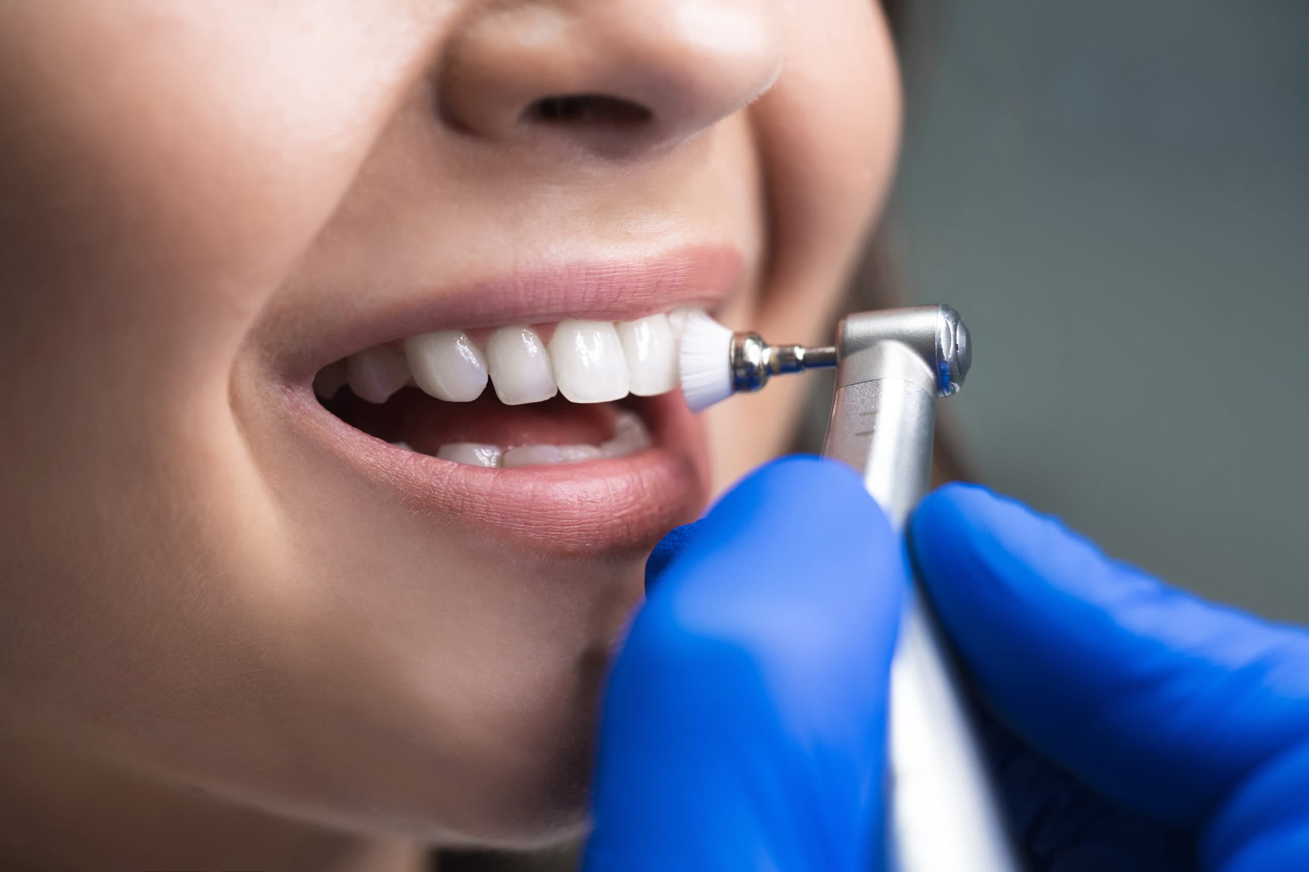 Regular Teeth Cleaning