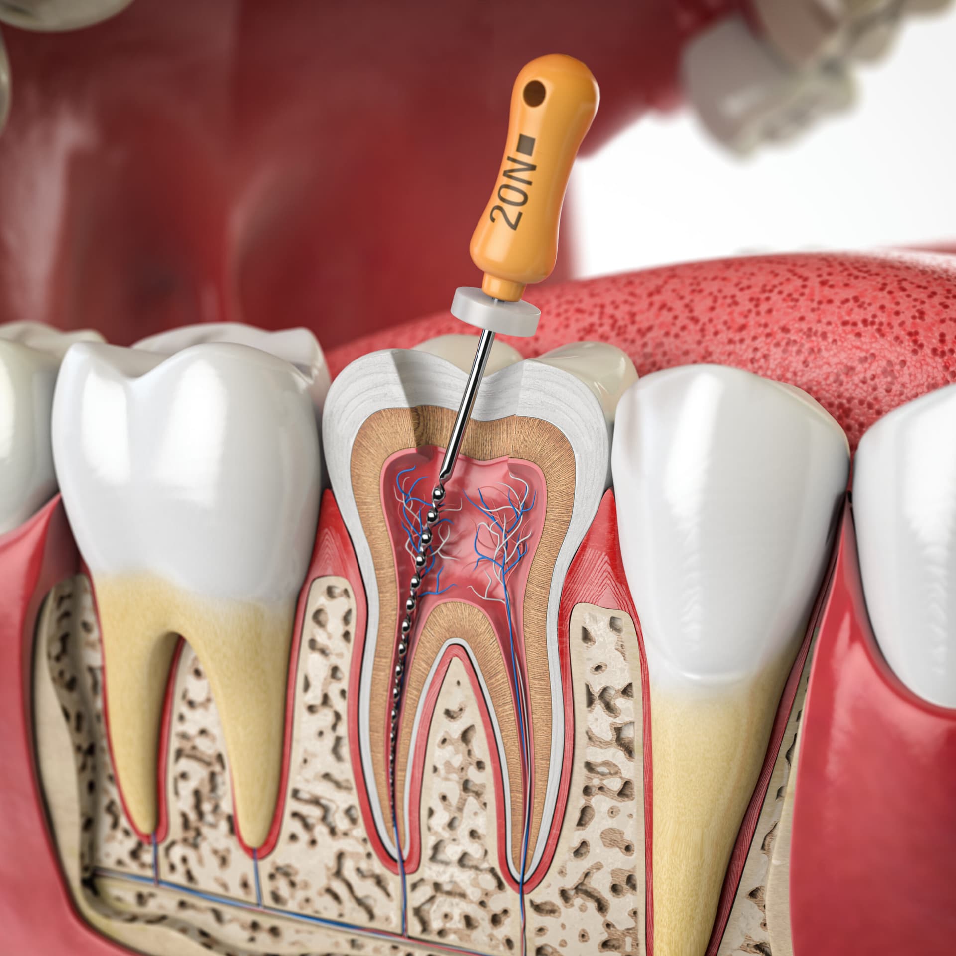 Root Canal Revision