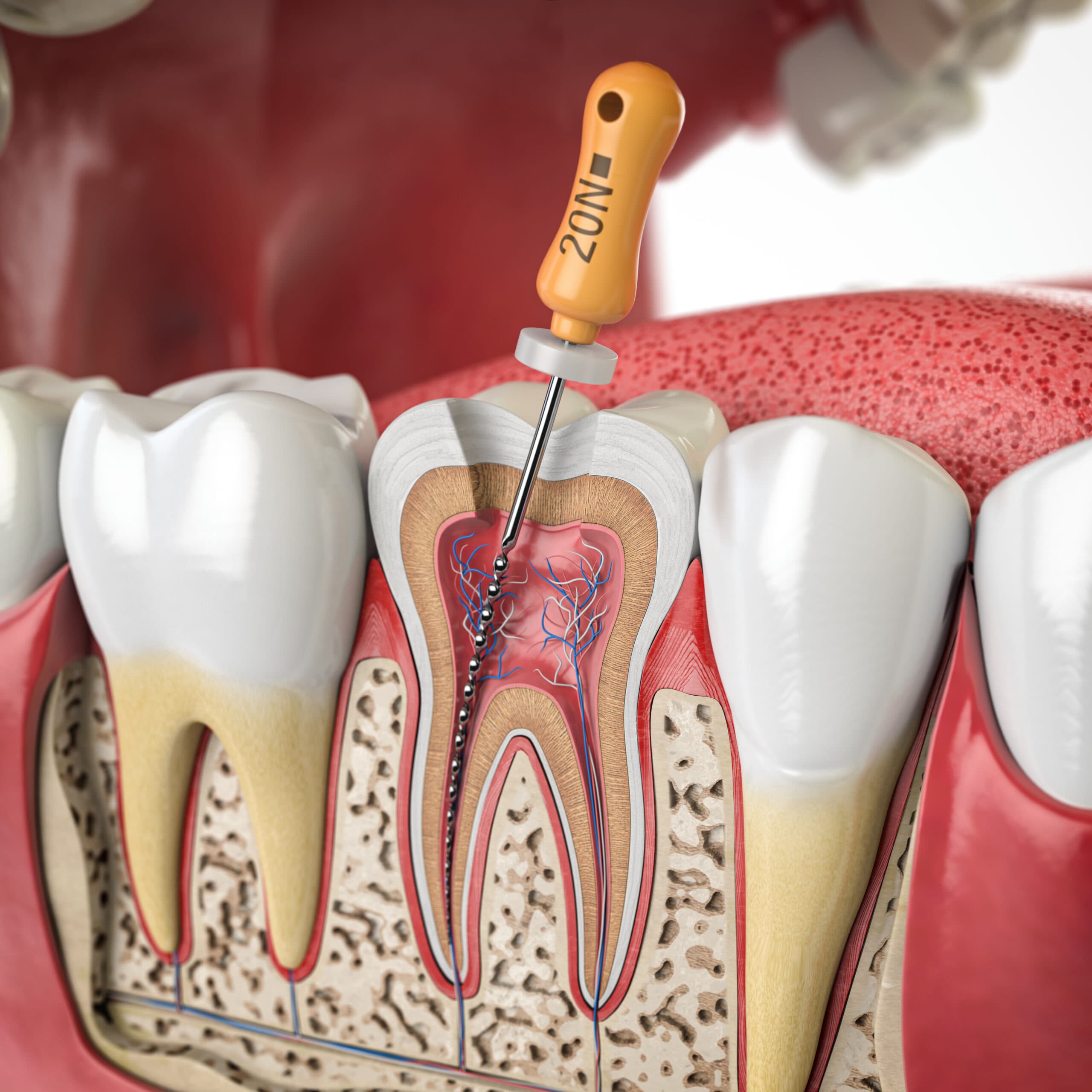 Root Canal Revision