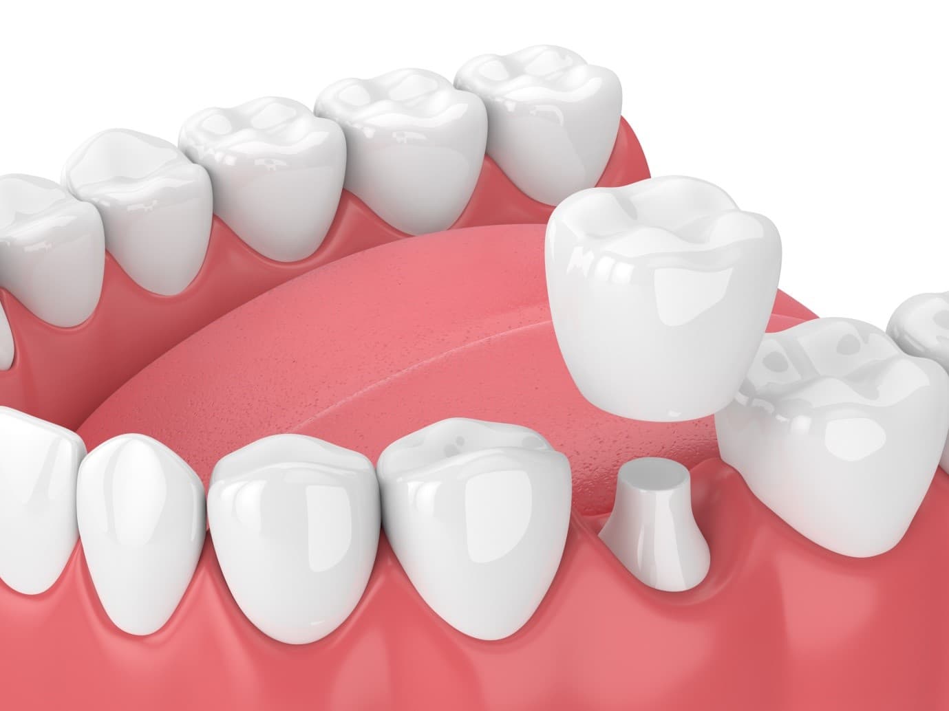 Same-Day Dental Crowns
