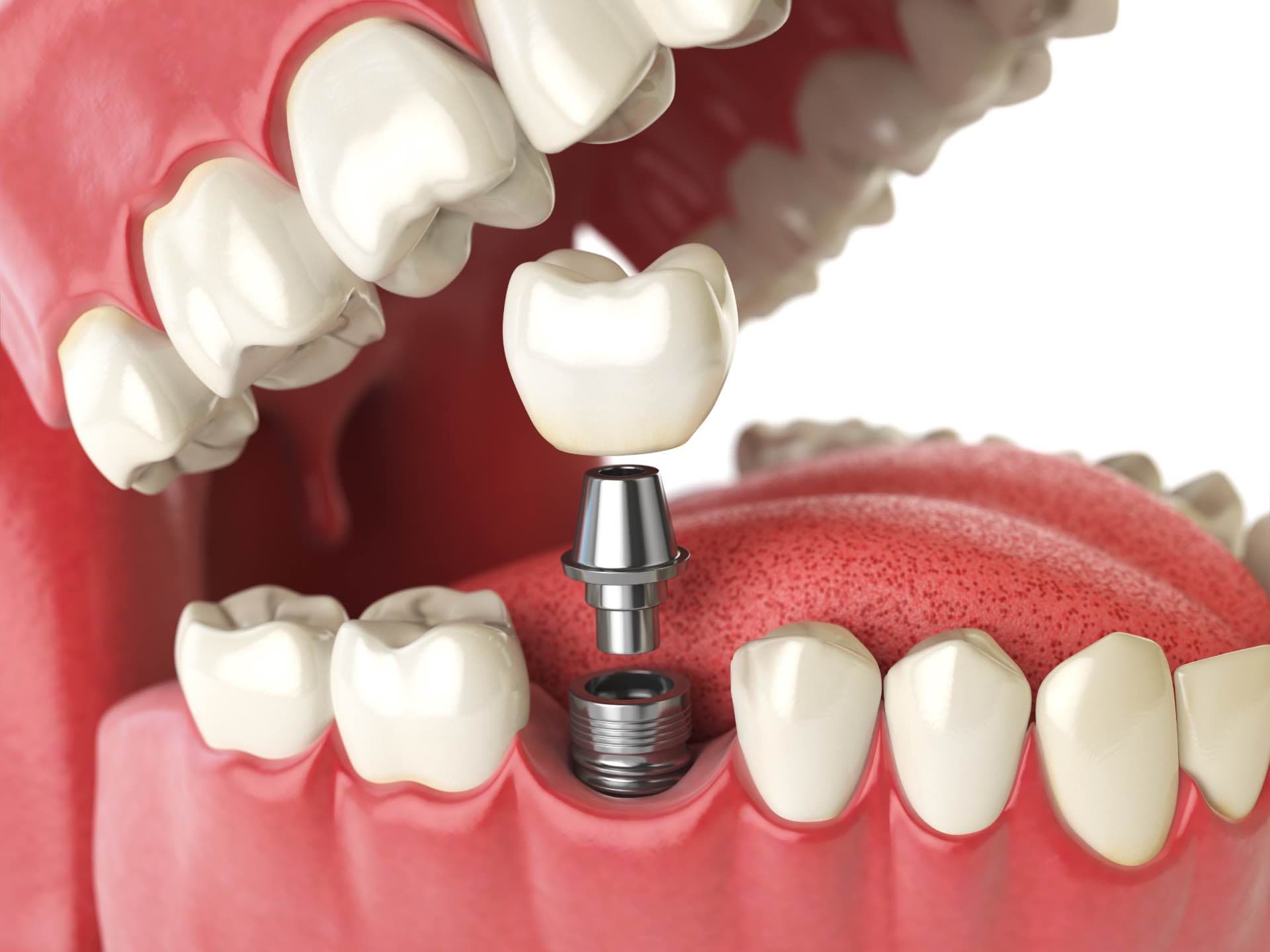 Same-Day Dental Implants