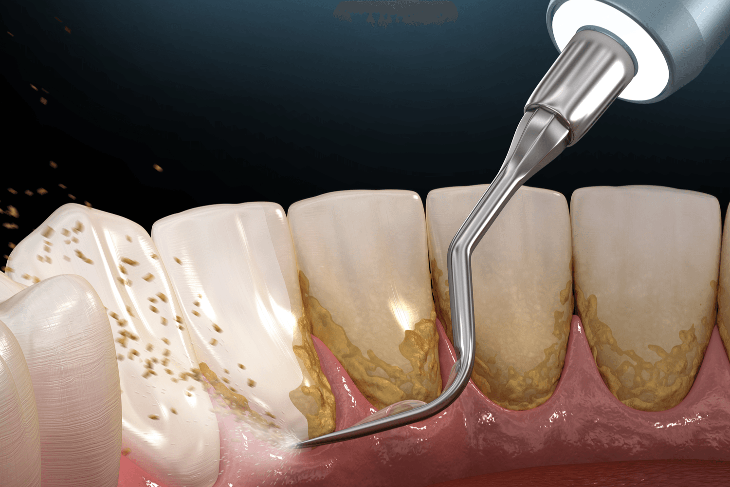 Scaling & Root Planning treatment at Smiles4Life Dental & Braces, Thousand Oaks