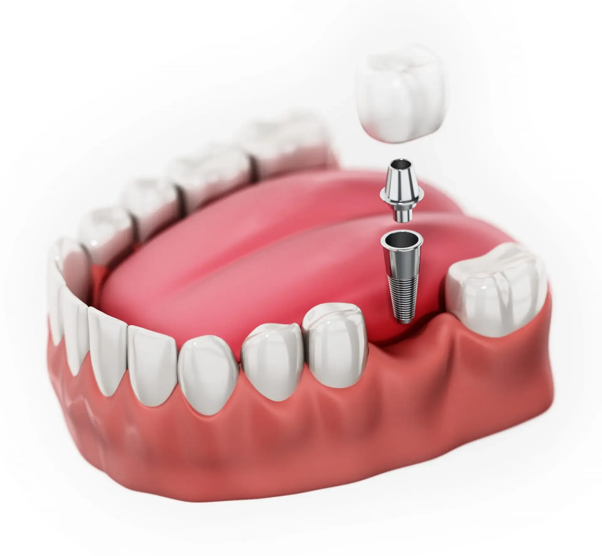 Single Tooth Implants