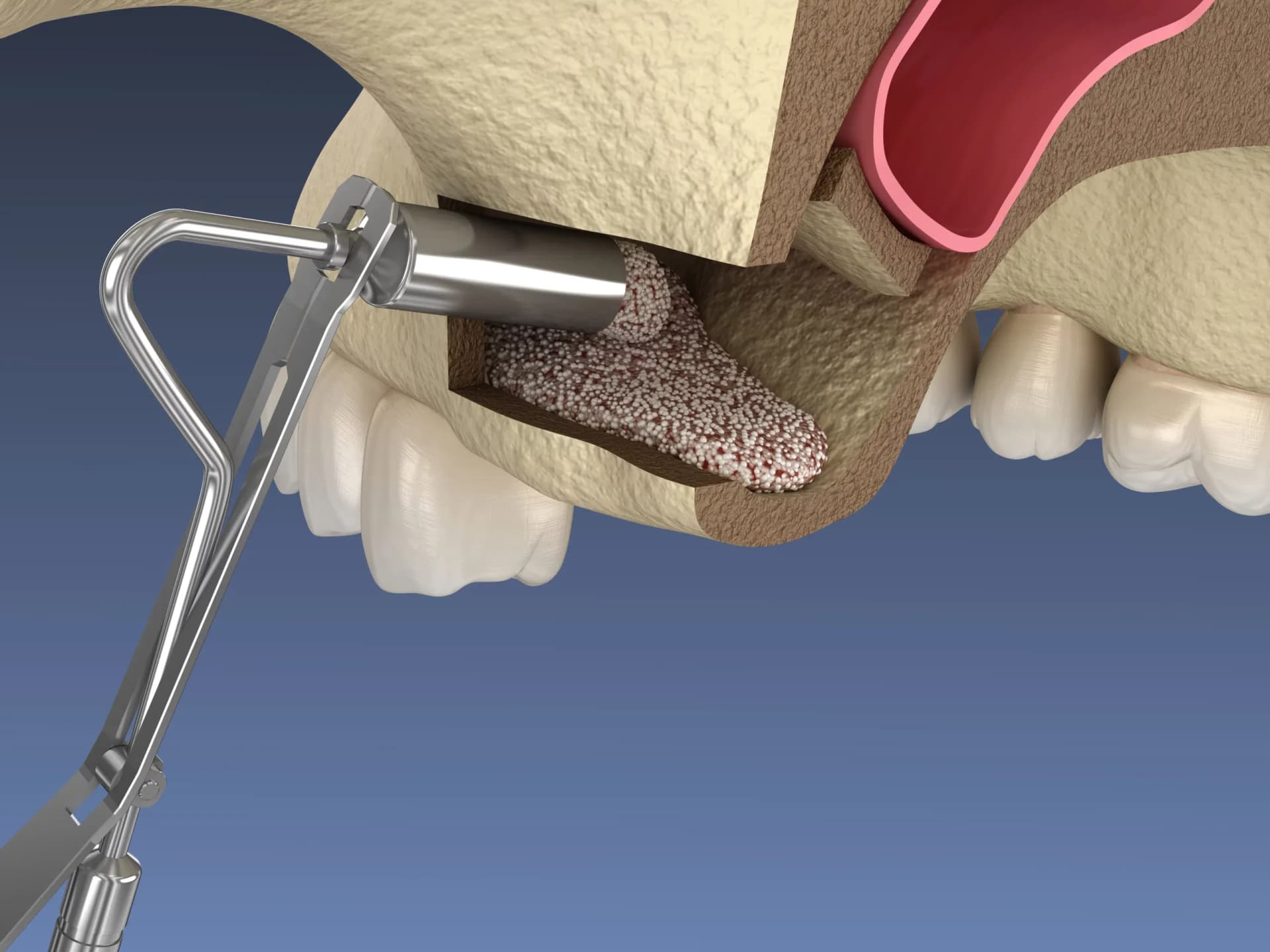 Sinus Lift Surgery