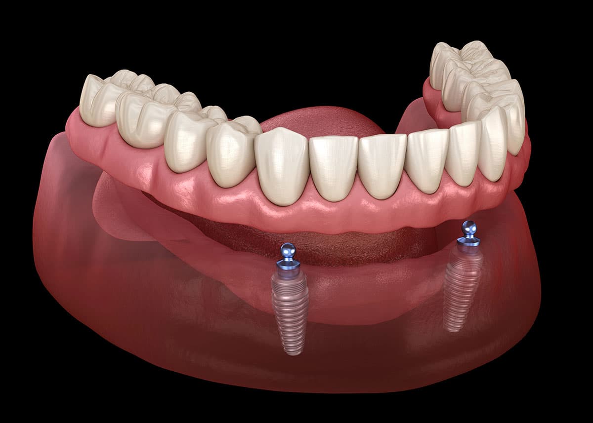 Snap-On Dentures