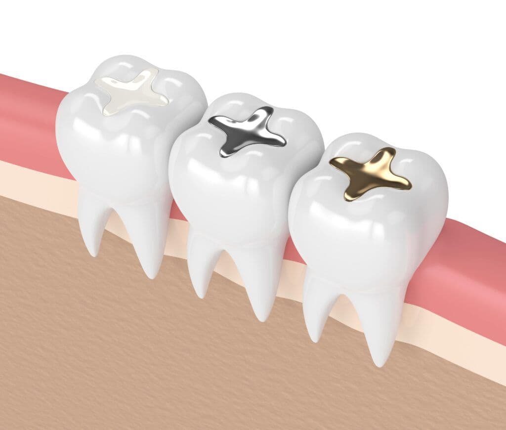 Tooth-Colored Fillings