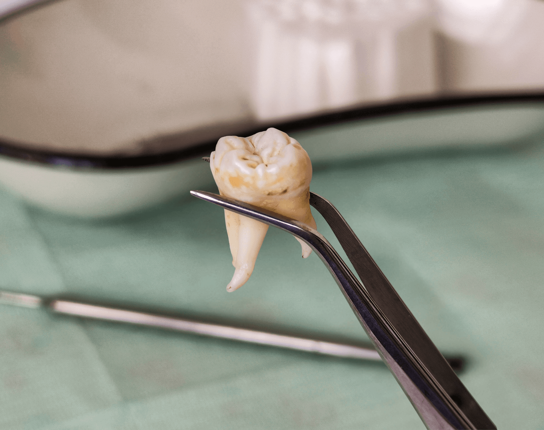 Wisdom Tooth Emergency Treatment